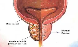 Uzman Ürologlar Eşliğinde Kronik Prostatit Tedavisi: Ankara'da Sağlığınızı Yenileyin