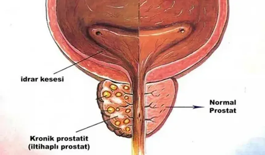 Uzman Ürologlar Eşliğinde Kronik Prostatit Tedavisi: Ankara'da Sağlığınızı Yenileyin